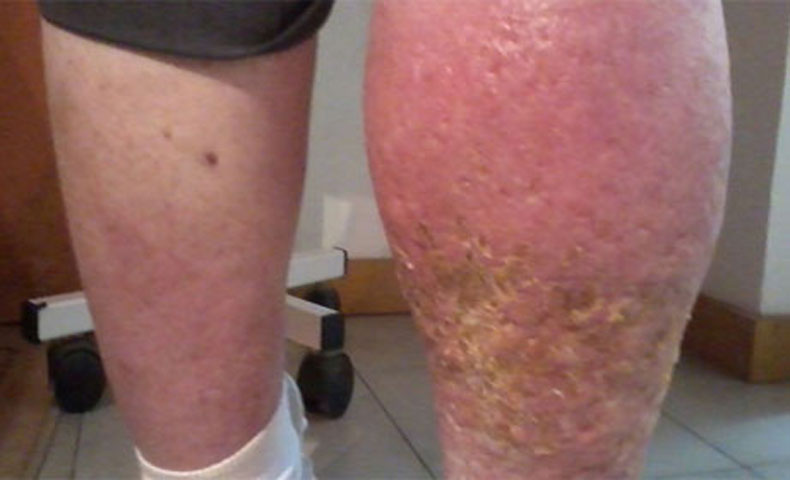sindrome post-tromboflebitica